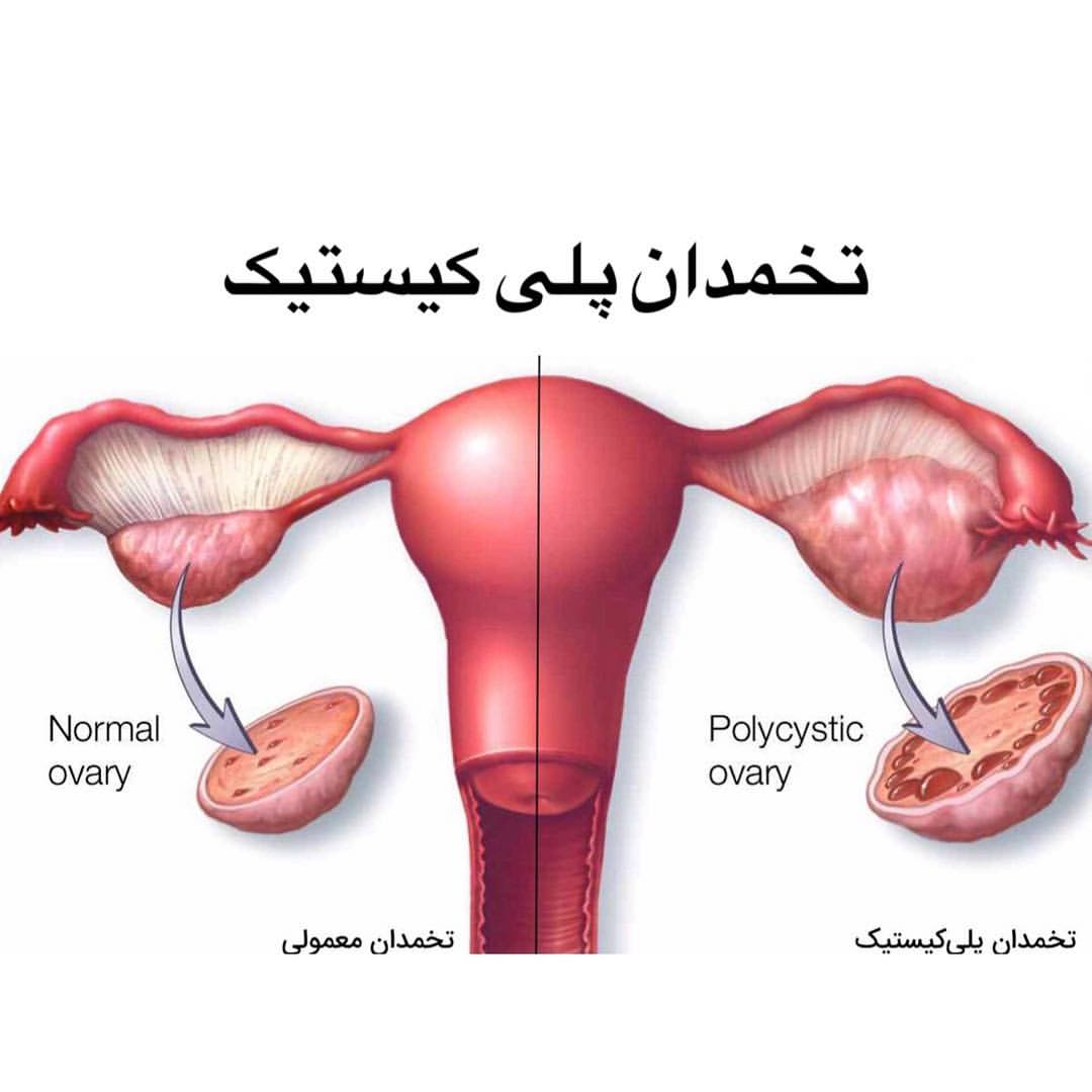 تخمدان پلی کیستیک