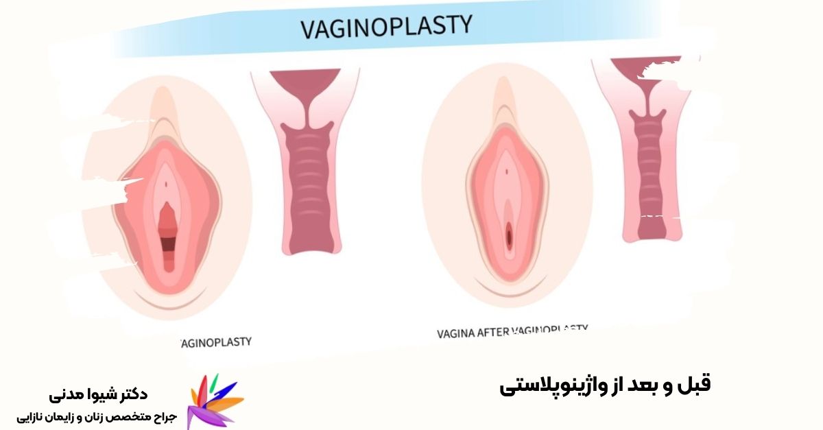 قبل و بعد از واژینوپلاستی: تغییرات ساختاری و جوان‌سازی ناحیه تناسلی