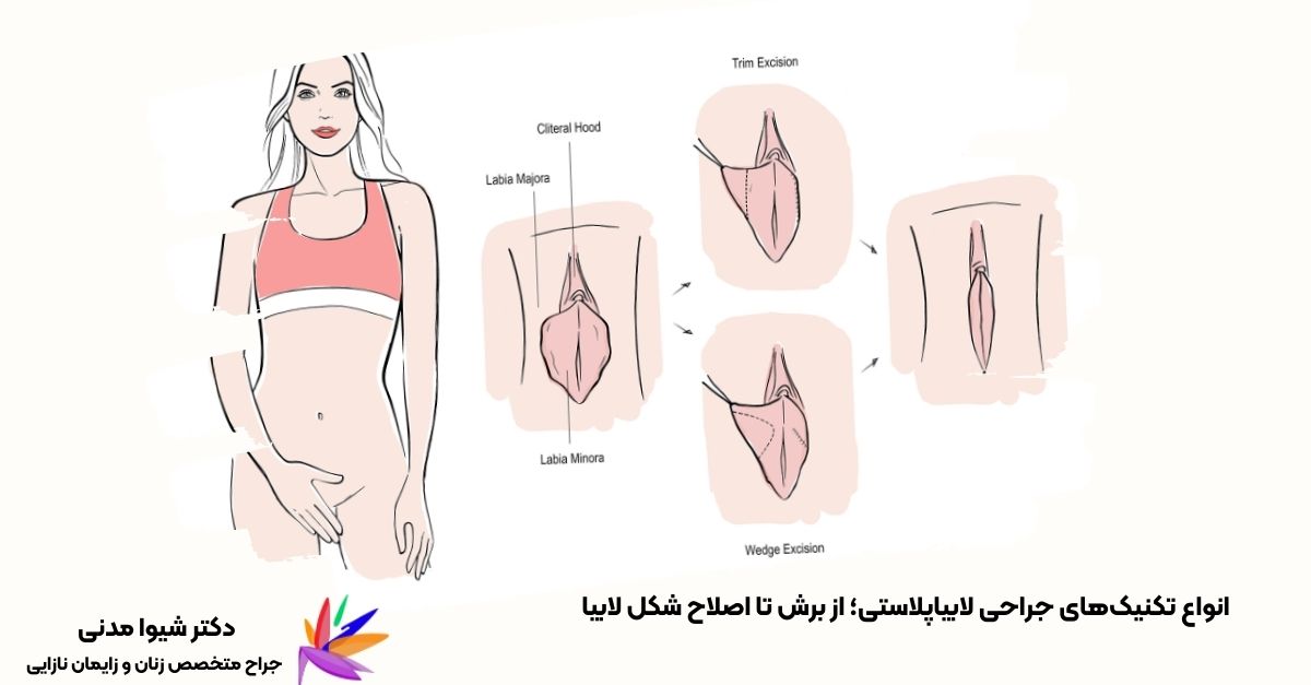 تصویری از انواع روش‌های جراحی لابیاپلاستی شامل تکنیک‌های برش مستقیم (Trim Excision) و برش گُوِه‌ای (Wedge Excision) که برای بهبود ظاهر و کاهش ناراحتی لابیا استفاده می‌شوند