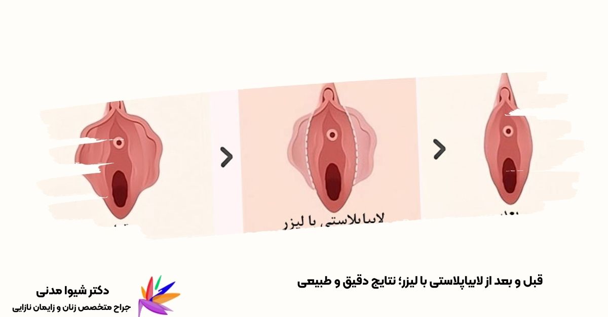 مقایسه نتایج لابیاپلاستی با لیزر؛ از حالت اولیه تا ظاهر بهبود یافته و طبیعی پس از جراحی، برای افزایش زیبایی و راحتی.