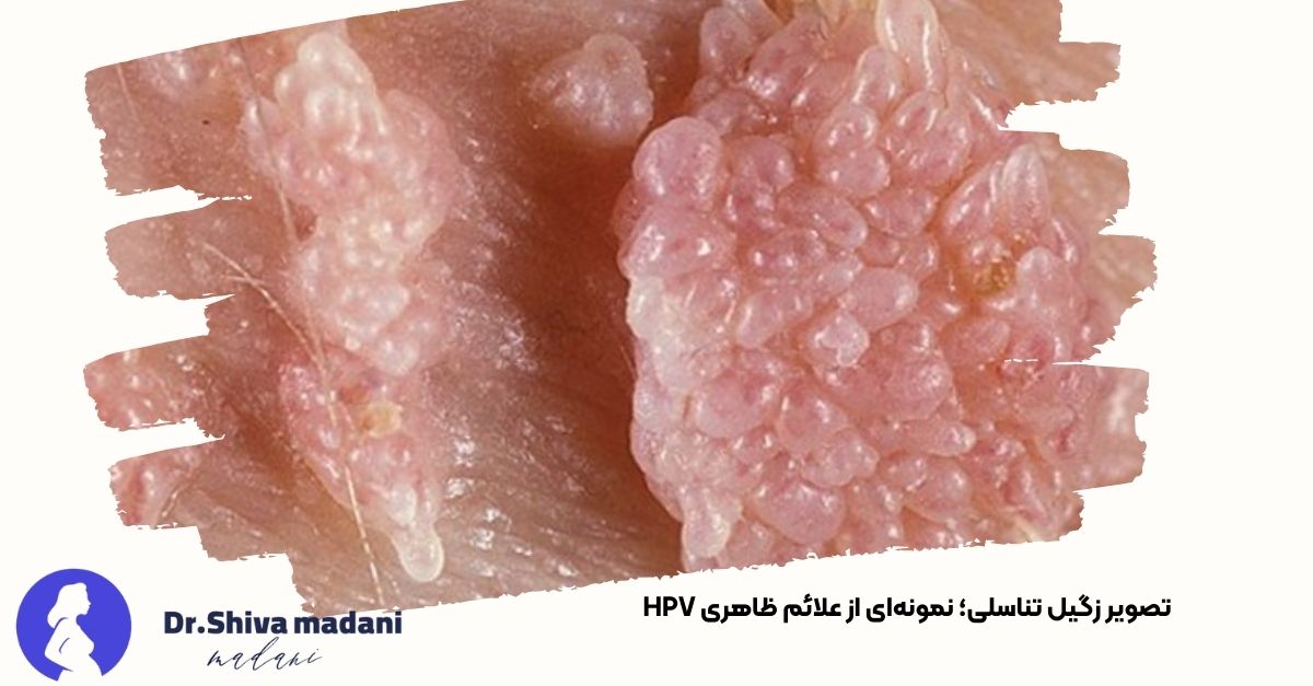 تصویری از زگیل تناسلی ناشی از ویروس HPV - دکتر شیوا مدنی حسینی