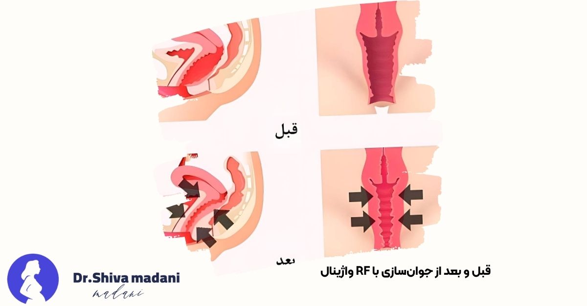  تصاویر قبل و بعد از استفاده از دستگاه RF واژینال - دکتر شیوا مدنی