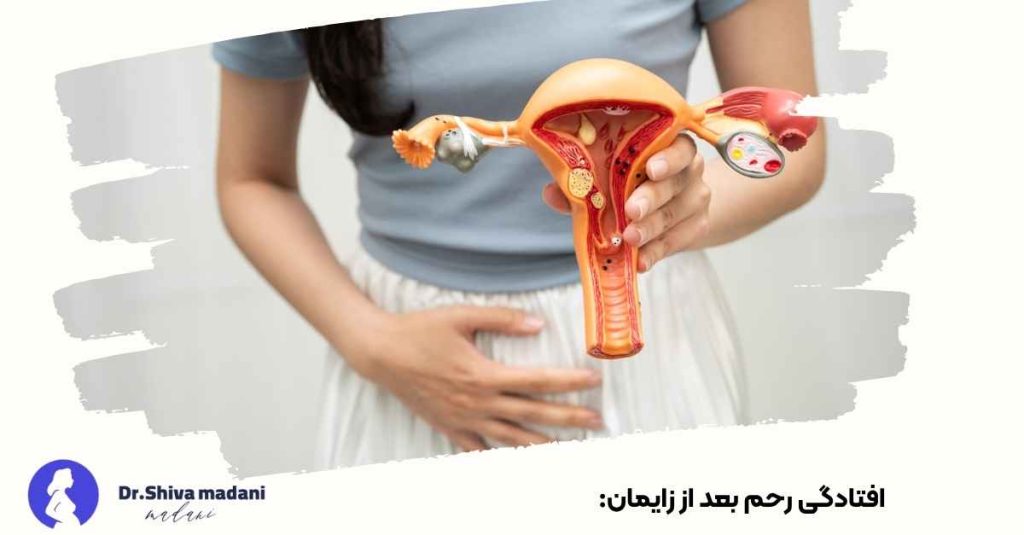 افتادگی رحم بعد از زایمان