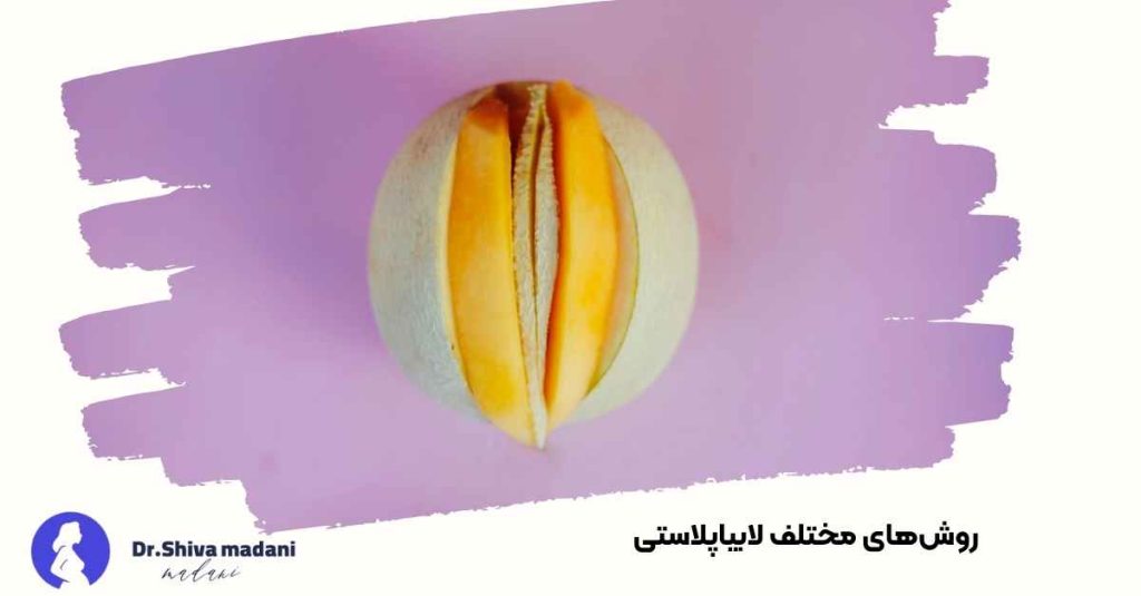 روش‌های مختلف لابیاپلاستی