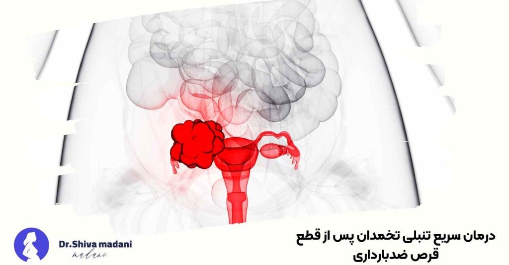 درمان سریع تنبلی تخمدان پس از قطع قرص ضدبارداری