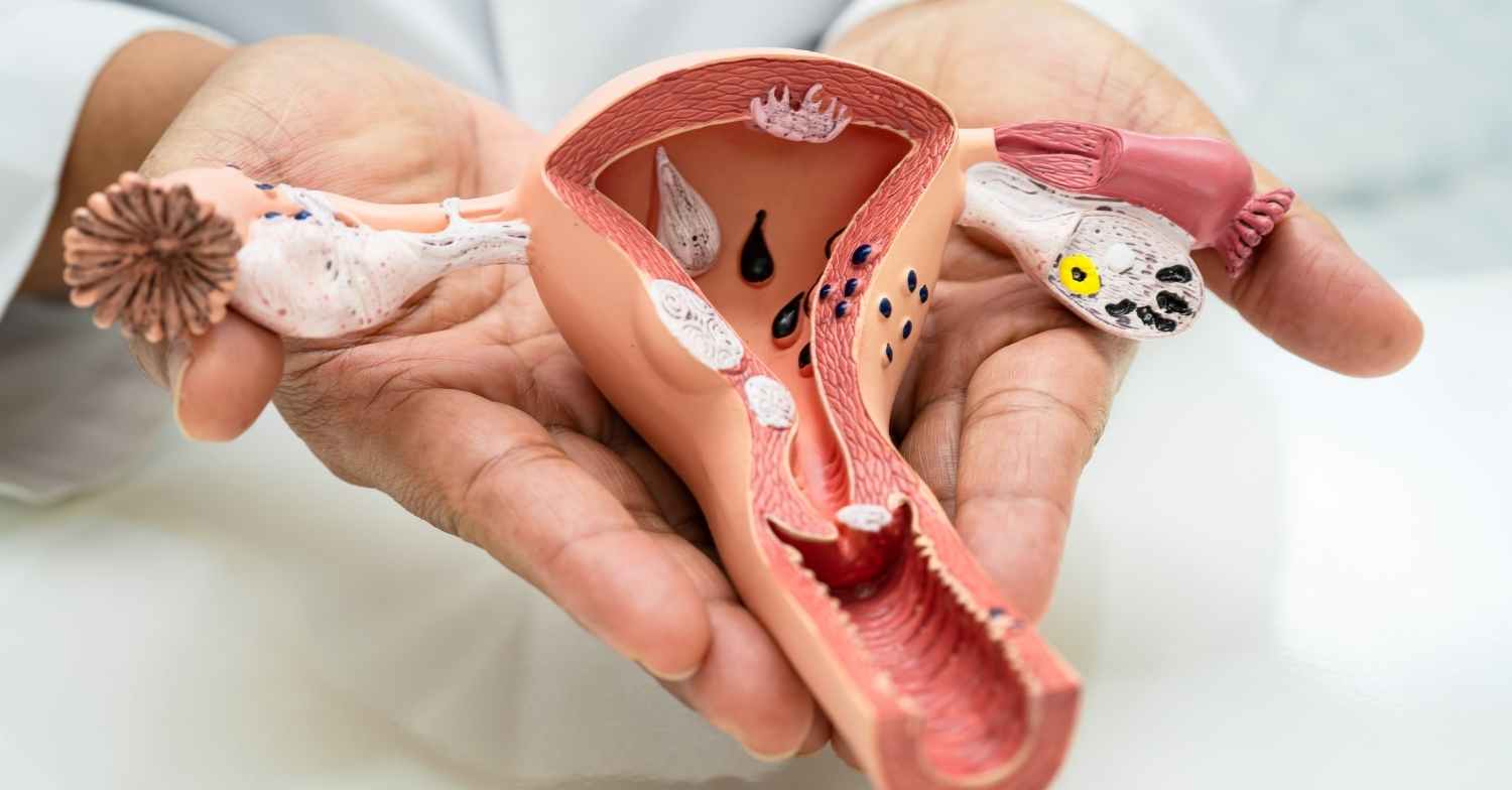 برای تنبلی تخمدان چه بخوریم